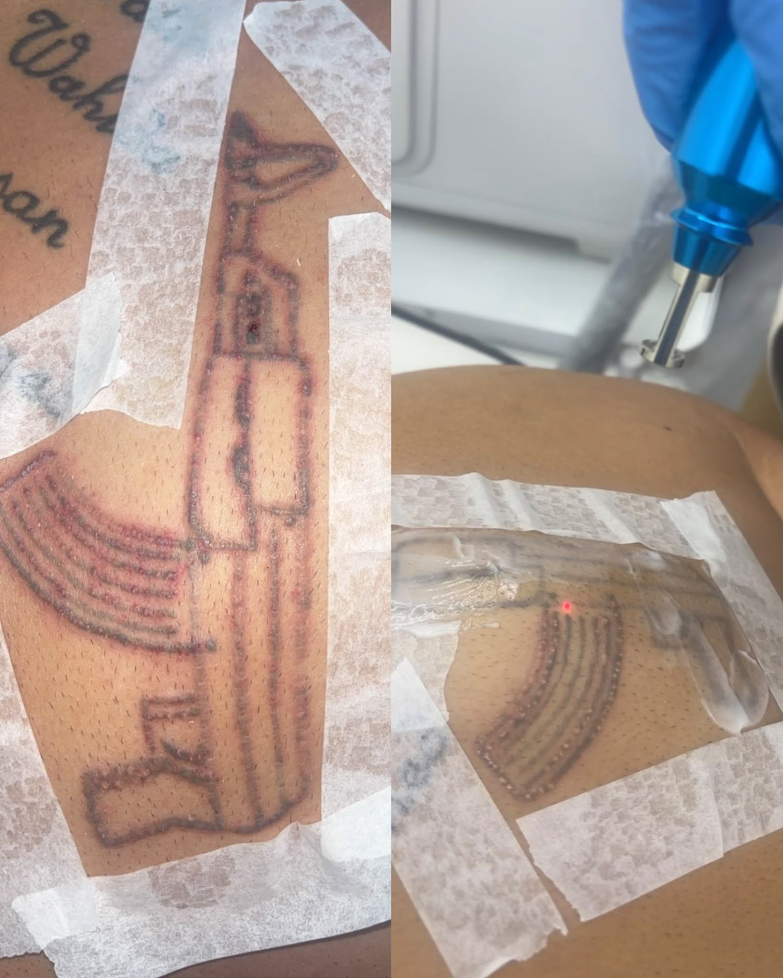 Tatueringsborttagning med laser hos Vana Beauty