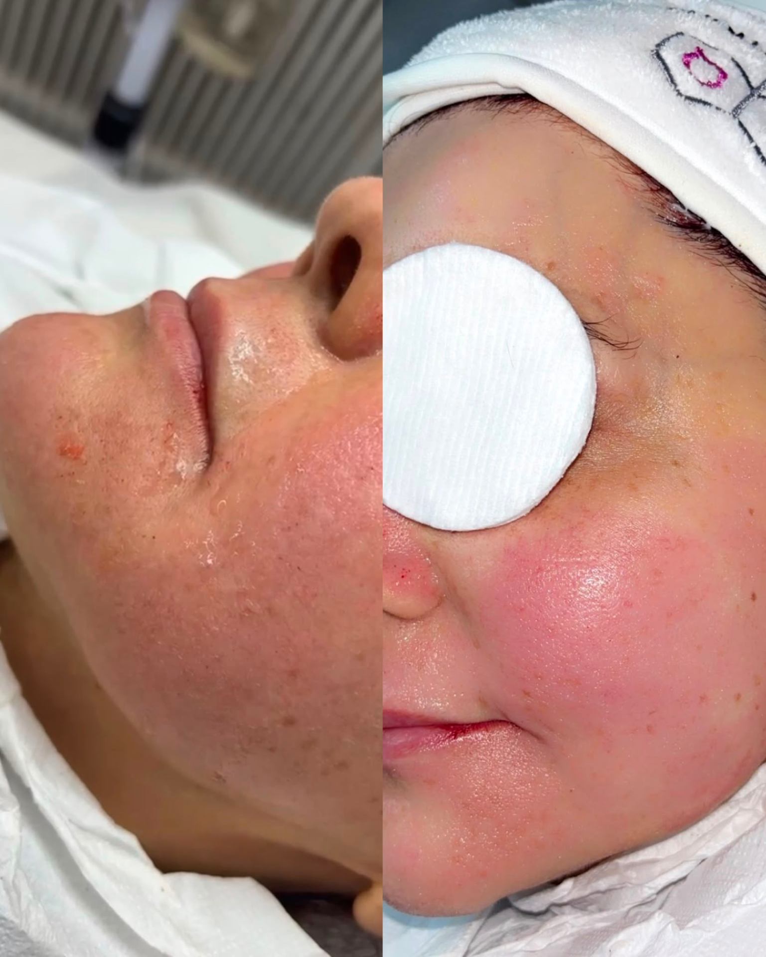 Före och efter microneedling hos Vana Beauty