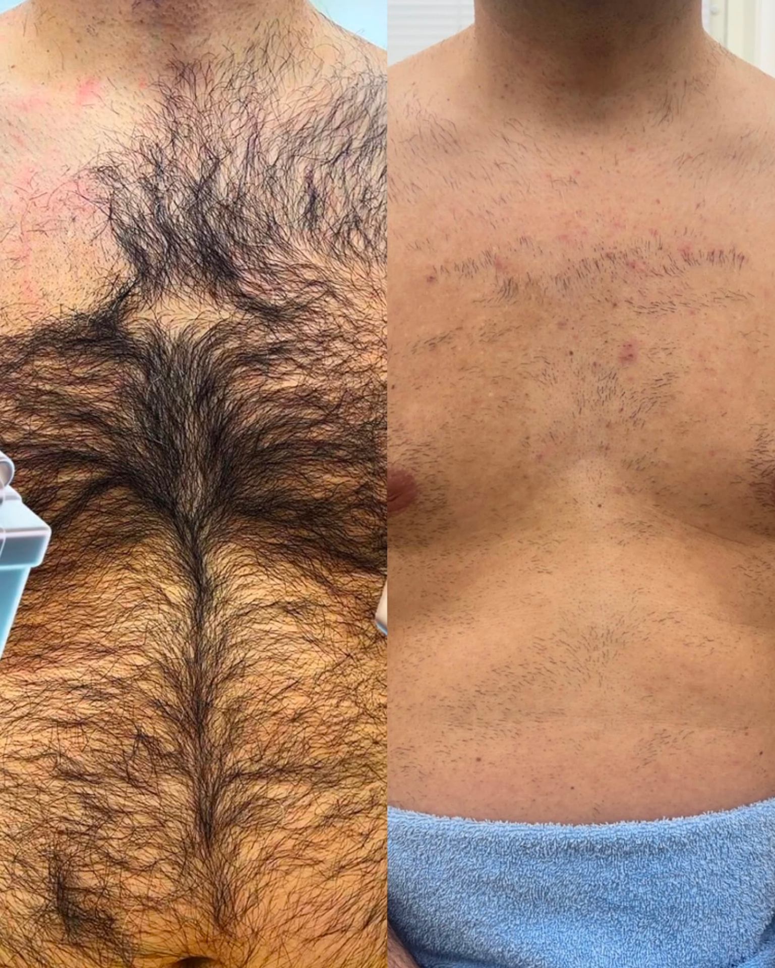 Före och efter laser hårborttagning på bröst hos Vana Beauty